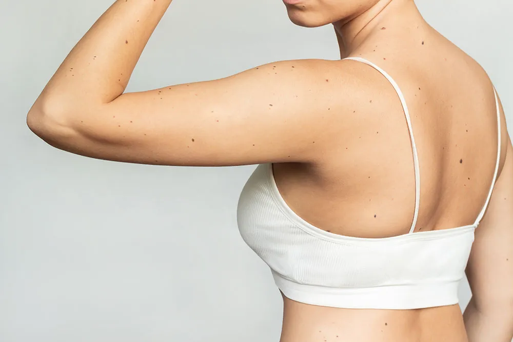 Arm Tuck Price: Understanding Costs of Arm Lift Surgery