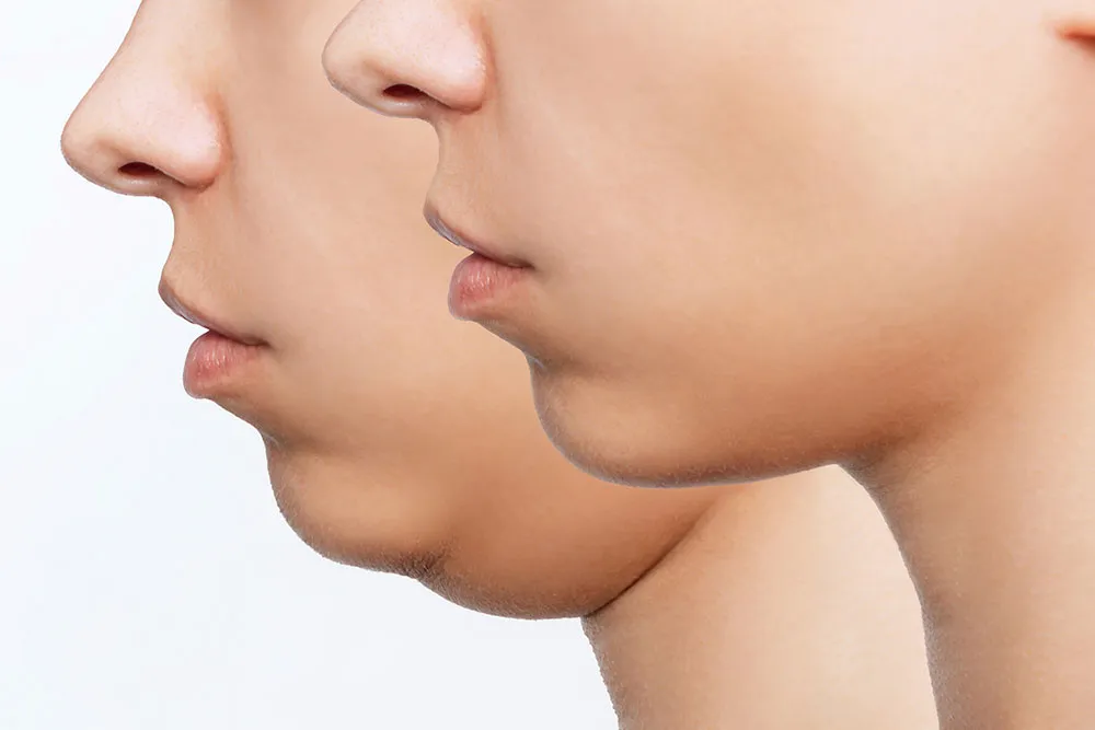 Buccal Fat Pads Removal Before and After: Understanding the Results