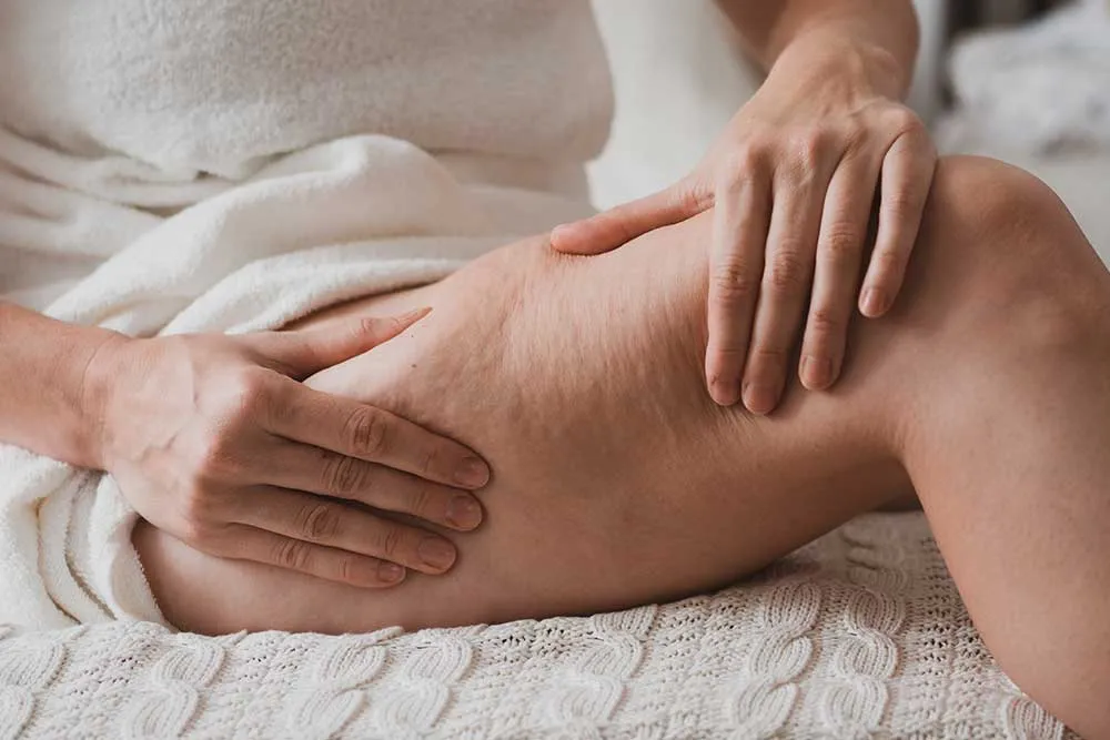 Cellulite Treatment Options: Effective Methods to Achieve Smoother Skin