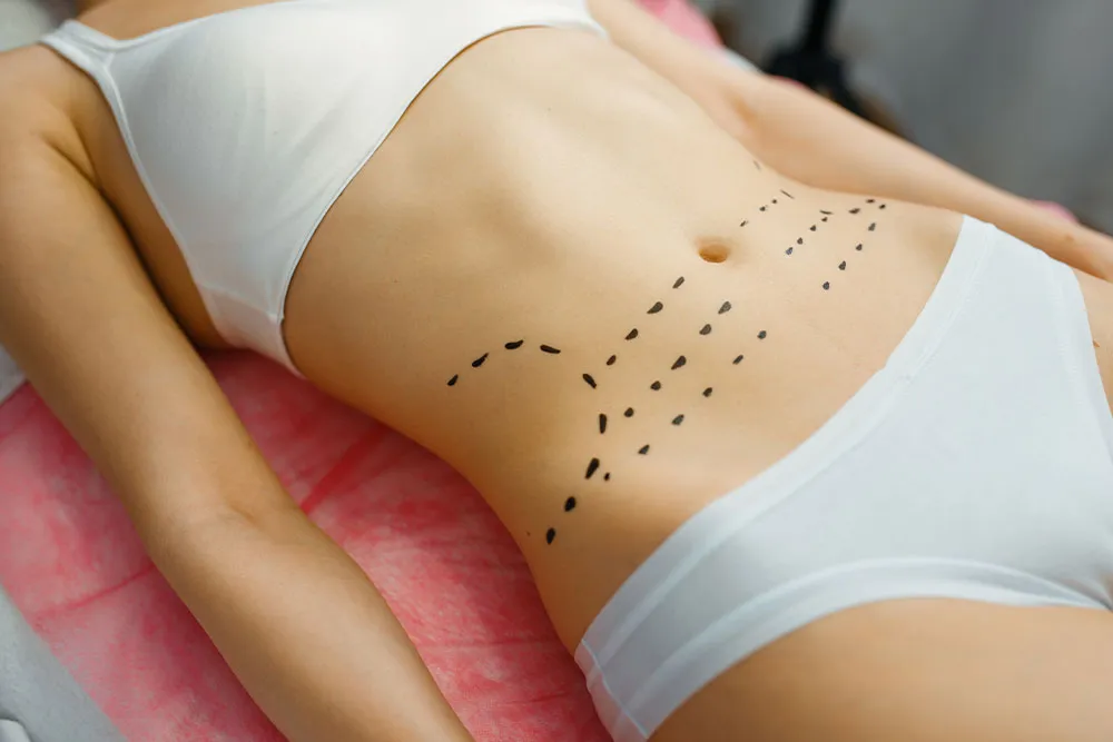 CoolSculpting vs Liposuction: Which Is Right for You?
