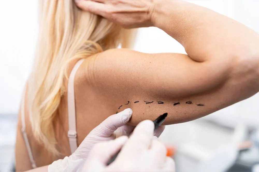 Cost of Arm Skin Removal: Understanding the Expenses for Brachioplasty