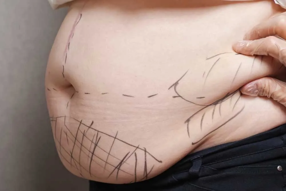 Cost of Liposuction Adelaide: Your Complete Guide to Pricing and Planning