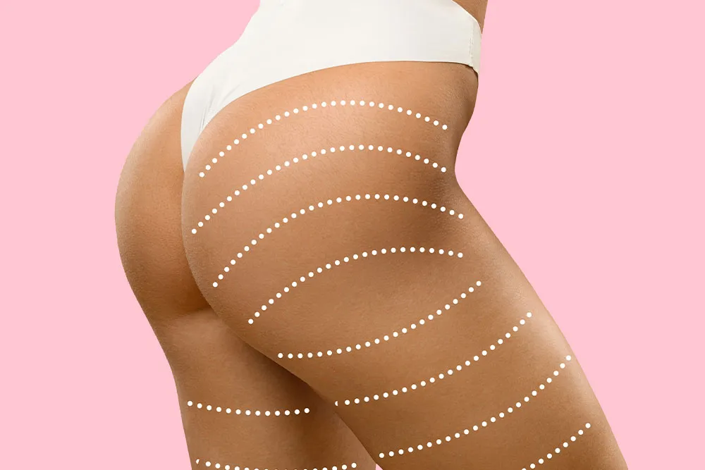 Current BBL Ladder: Understanding Popularity and Trends in Brazilian Butt Lift