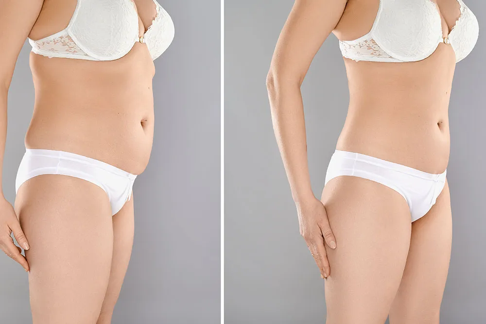 Fat Freezing Before And After: What to Expect From Cryolipolysis