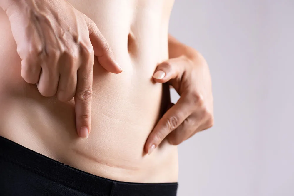Liposuction Before and After Scars: What to Expect and How to Minimize Them