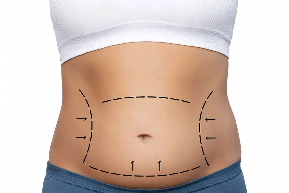 Non-Surgical Liposuction: Comprehensive Guide to Non-Invasive Fat Reduction
