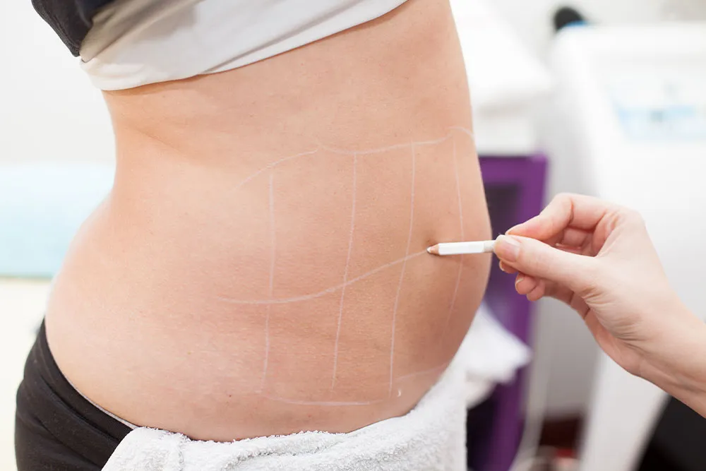 Surgical Skin Removal: A Complete Guide to Body Contouring Surgery
