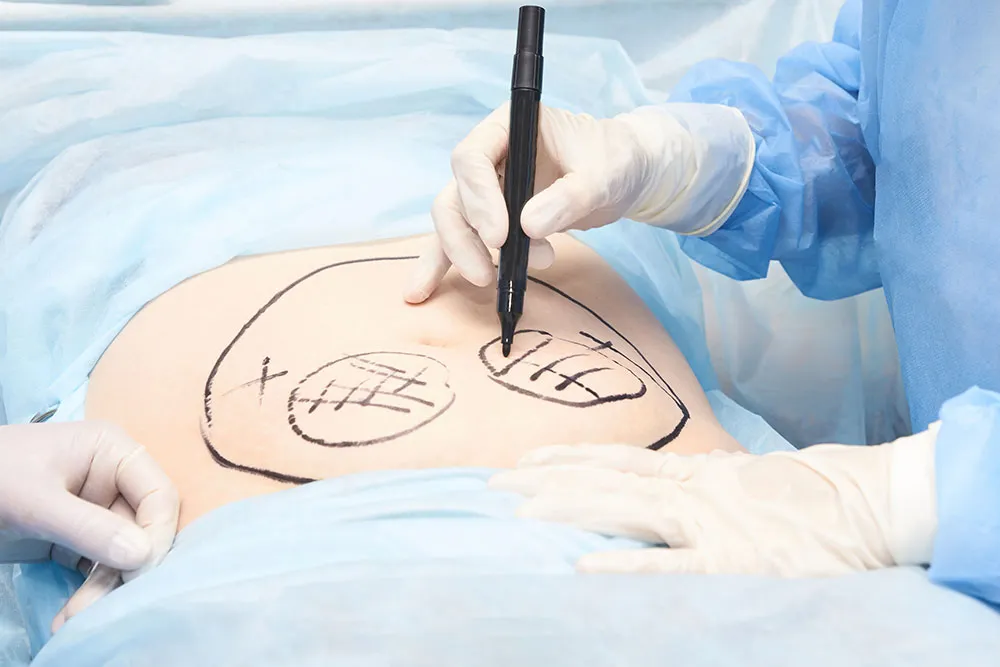 Tummy Tuck Operation Procedure: Comprehensive Guide to Abdominoplasty