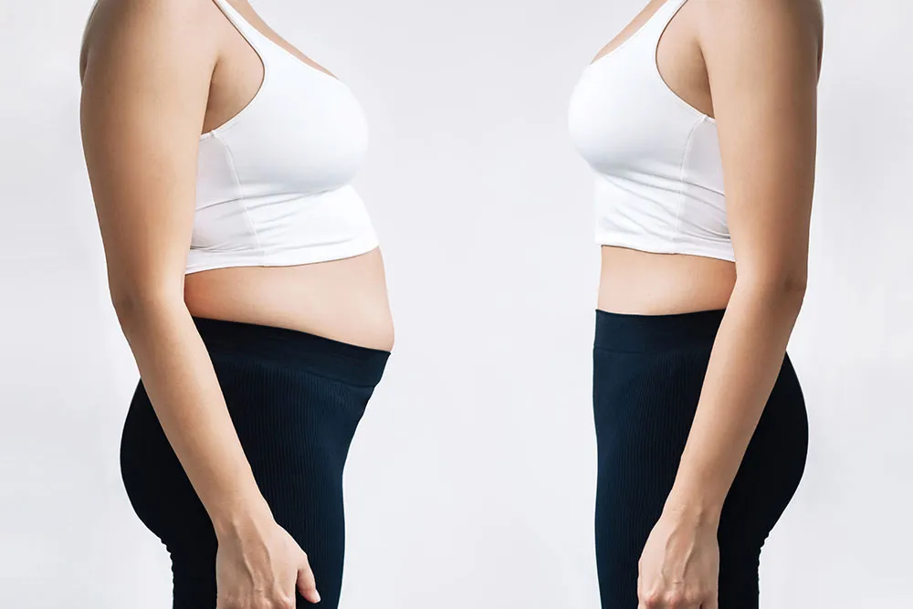 Vaser Lipo Before and After: Transformative Results You Can Expect